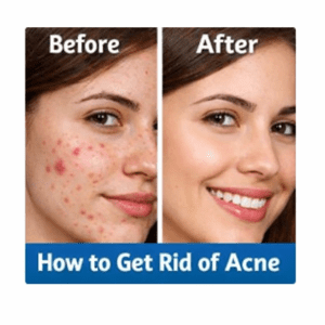 How to get rid of acne.